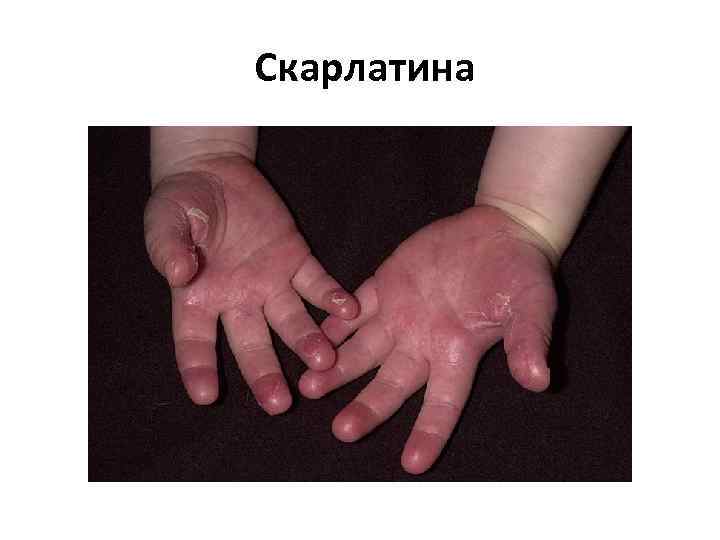  Скарлатина 