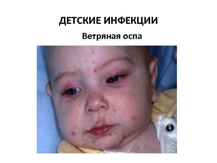 ДЕТСКИЕ ИНФЕКЦИИ Ветряная оспа 