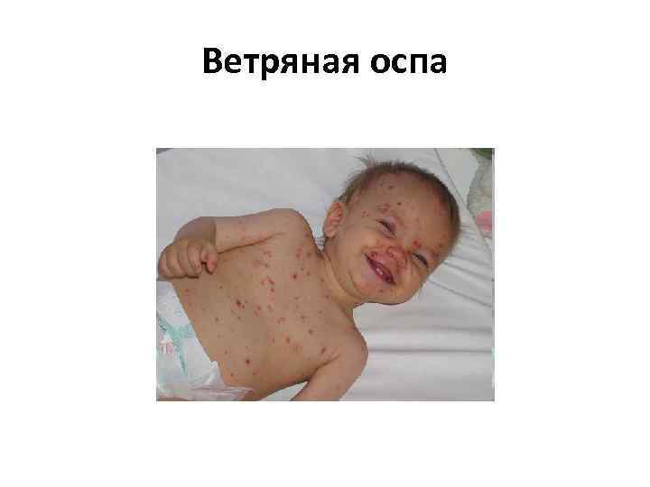 Ветряная оспа 