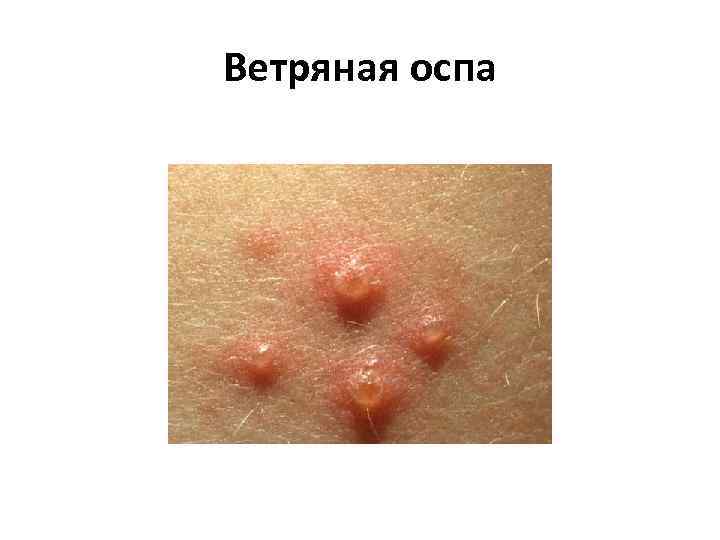 Ветряная оспа 