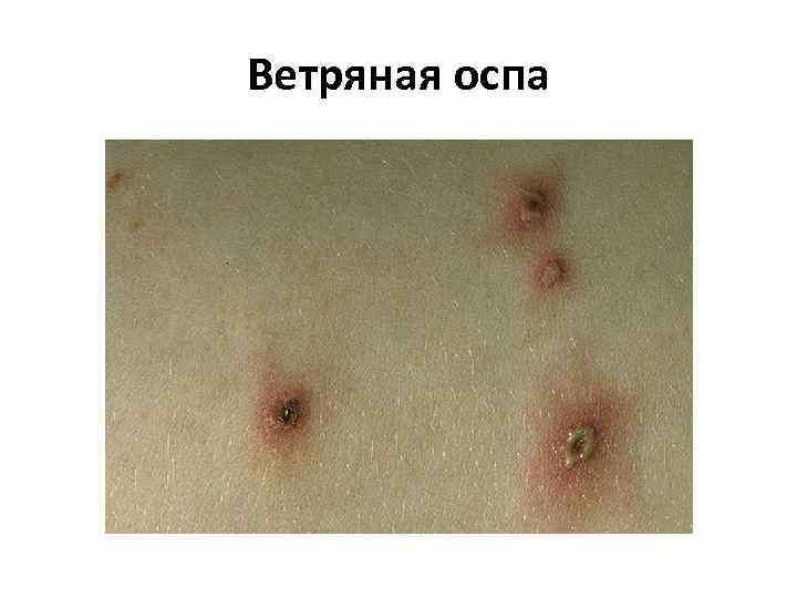 Ветряная оспа 