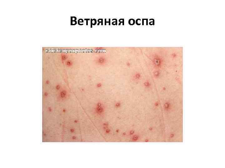 Ветряная оспа 