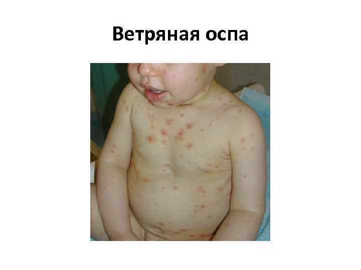 Ветряная оспа 