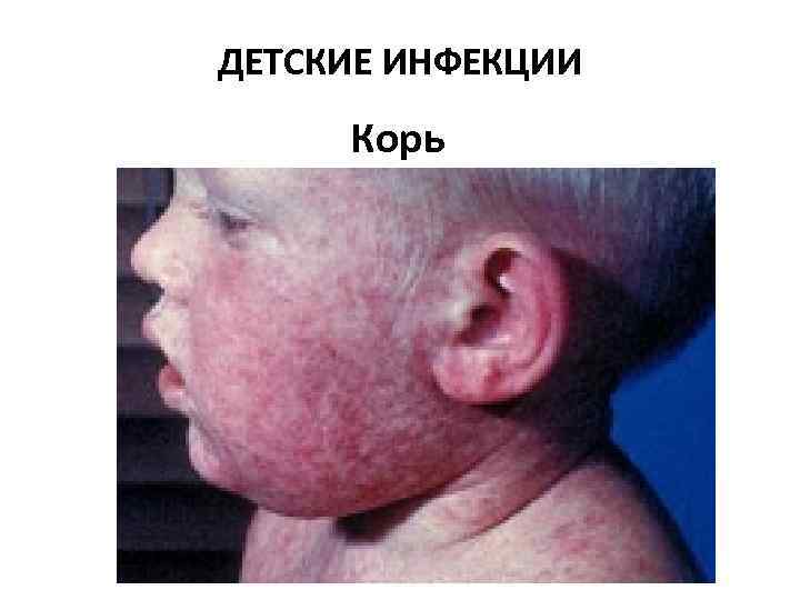 ДЕТСКИЕ ИНФЕКЦИИ Корь 