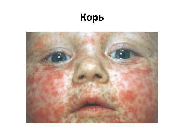 Корь 