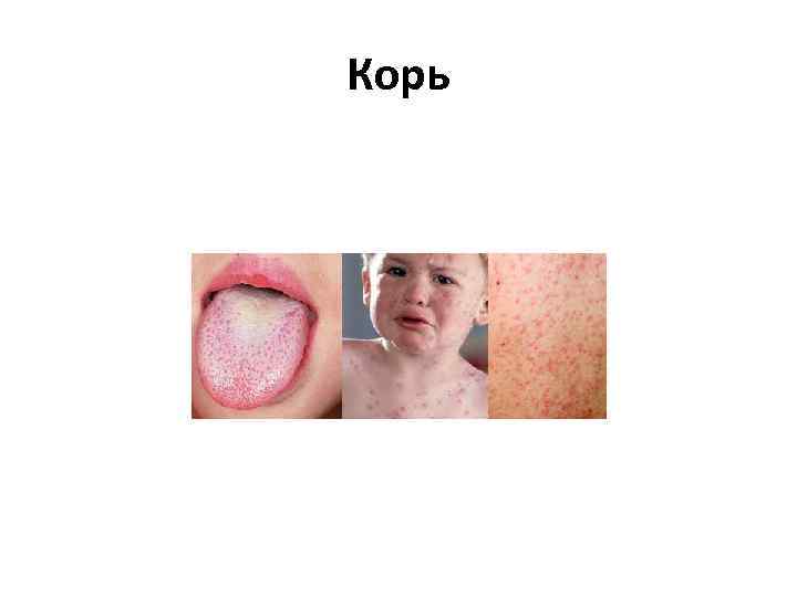 Корь 