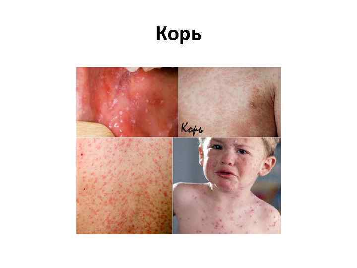 Корь 