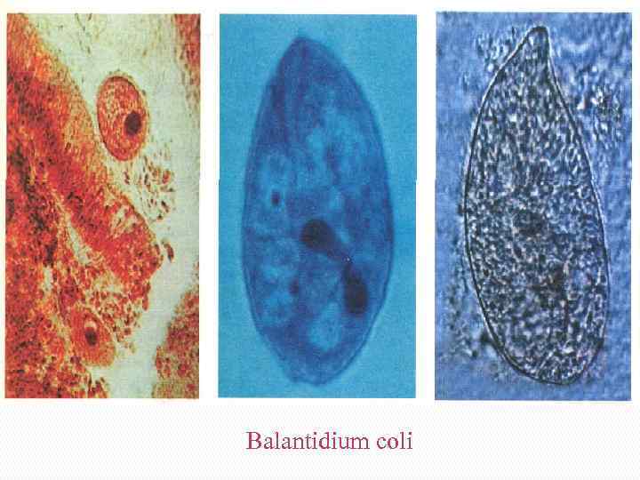 Balantidium coli 