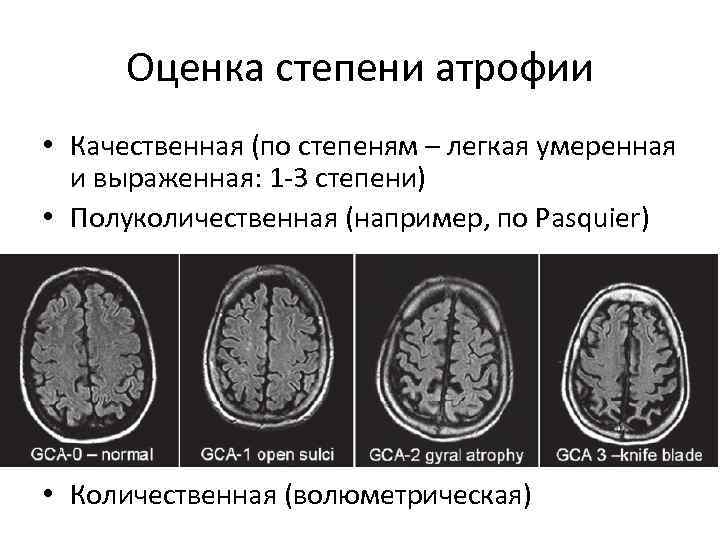 Оценка степени атрофии • Качественная (по степеням – легкая умеренная и выраженная: 1 -3