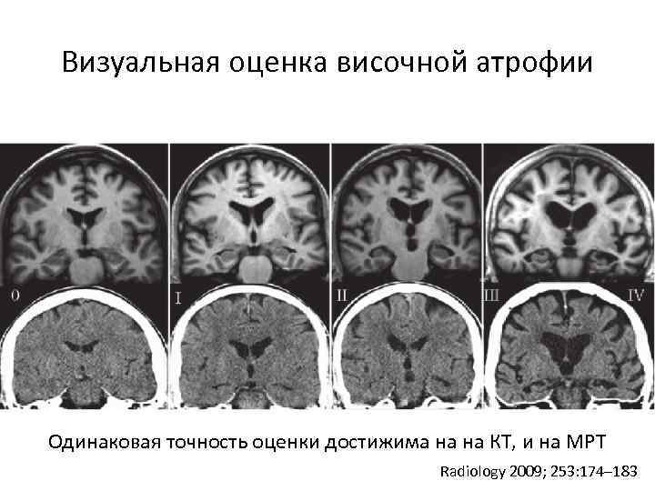 Гидроцефалия на фоне кортикальной атрофии