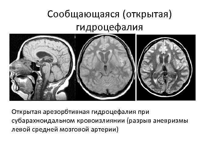 Сообщающаяся (открытая) гидроцефалия Открытая арезорбтивная гидроцефалия при субарахноидальном кровоизлиянии (разрыв аневризмы левой средней мозговой