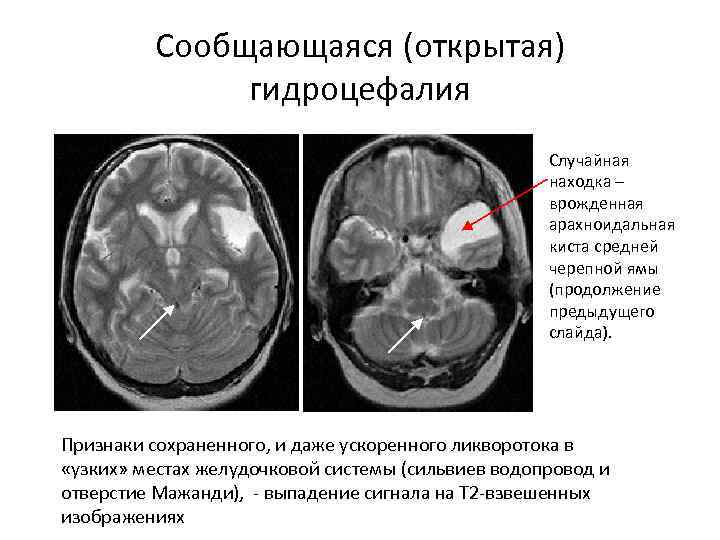 Мр картина нерезкой наружной гидроцефалии что это