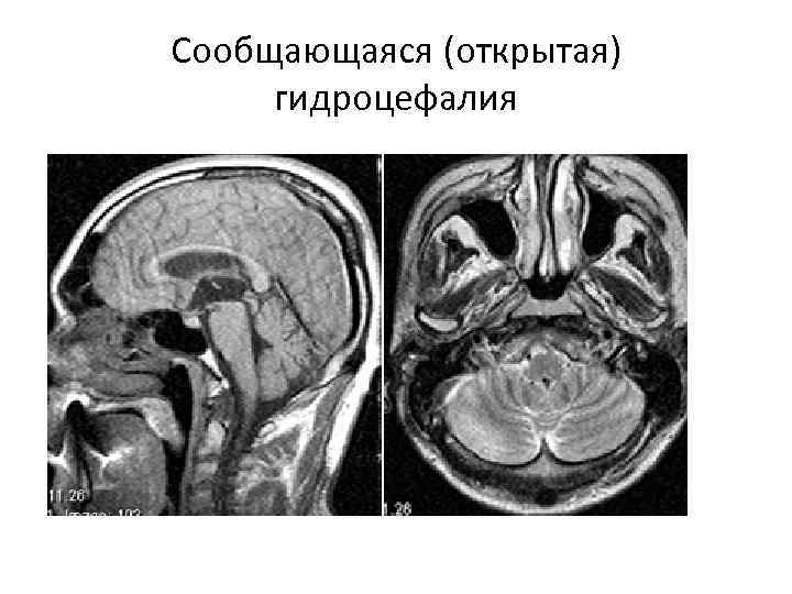 Сообщающаяся (открытая) гидроцефалия 