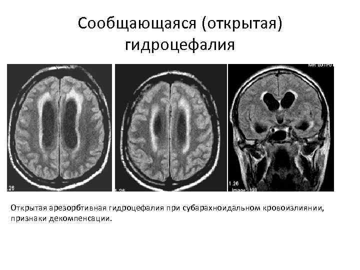 Сообщающаяся (открытая) гидроцефалия Открытая арезорбтивная гидроцефалия при субарахноидальном кровоизлиянии, признаки декомпенсации. 