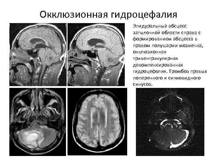 Абсцесс челюстно лицевой области фото