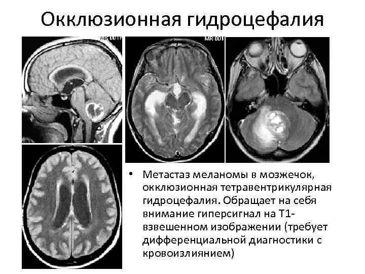 Гидроцефалия на фоне кортикальной атрофии