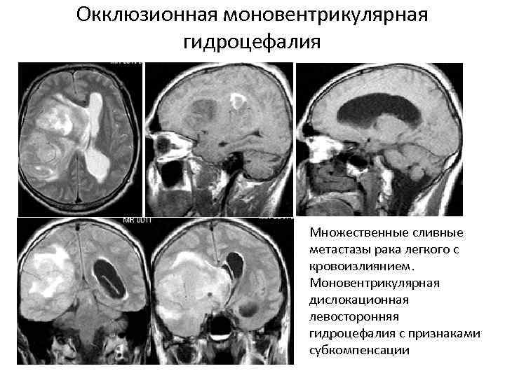 Окклюзионная моновентрикулярная гидроцефалия Множественные сливные метастазы рака легкого с кровоизлиянием. Моновентрикулярная дислокационная левосторонняя гидроцефалия