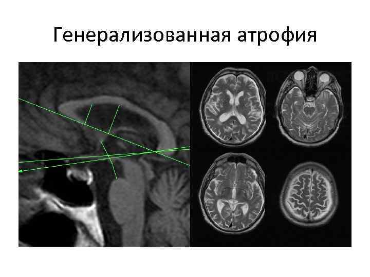 Заместительная гидроцефалия