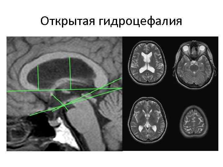 Открытая гидроцефалия 