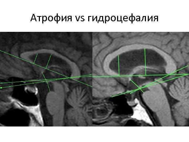 Атрофия vs гидроцефалия 