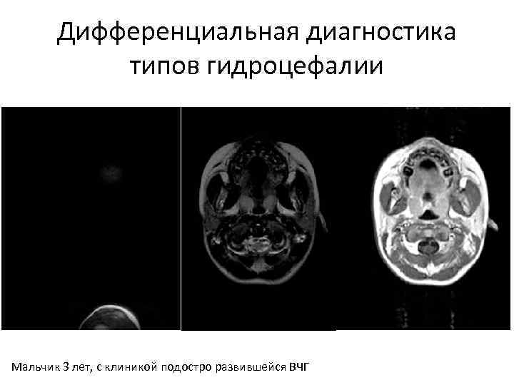 Дифференциальная диагностика типов гидроцефалии Мальчик 3 лет, с клиникой подостро развившейся ВЧГ 