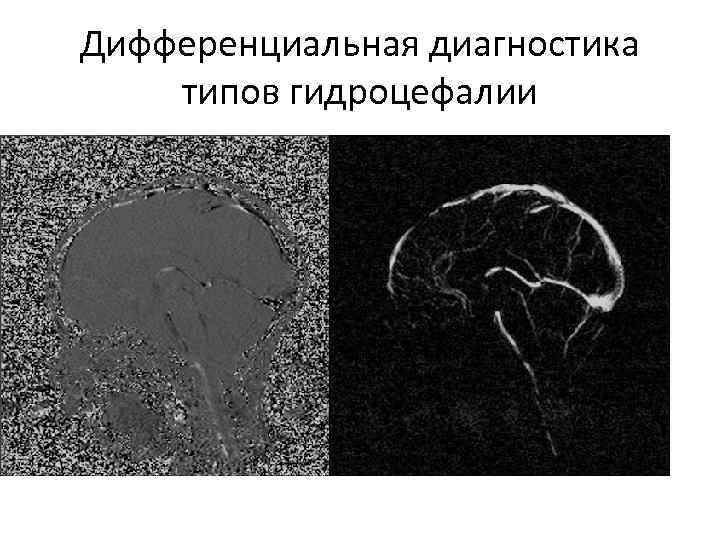 Дифференциальная диагностика типов гидроцефалии 