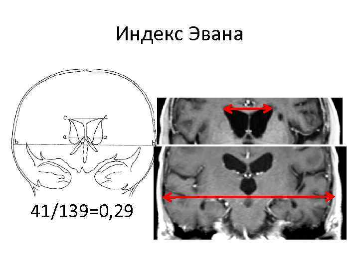 Индекс Эвана 41/139=0, 29 