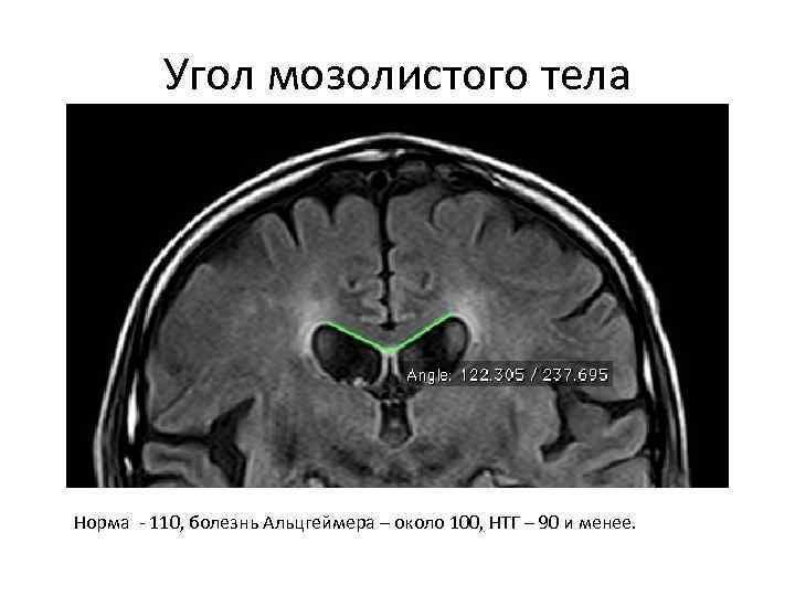 Угол мозолистого тела Норма - 110, болезнь Альцгеймера – около 100, НТГ – 90