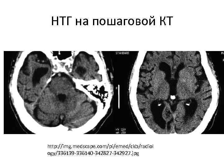 НТГ на пошаговой КТ http: //img. medscape. com/pi/emed/ckb/radiol ogy/336139 -336140 -342827 -342927. jpg 