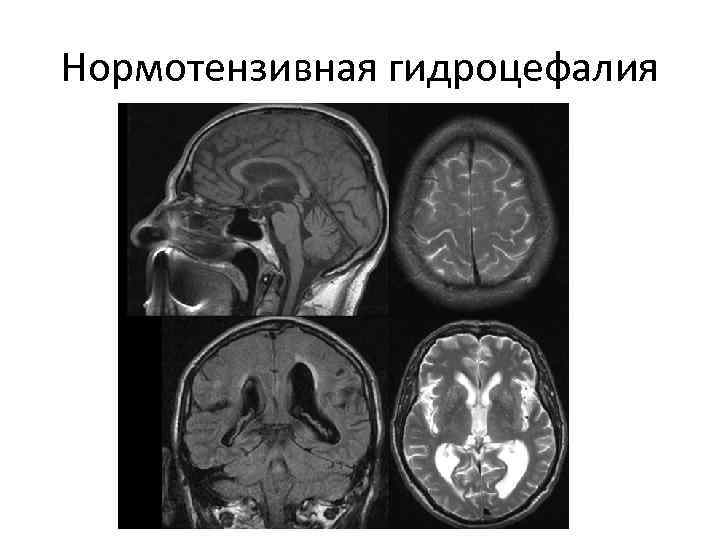 Мр картина наружной заместительной гидроцефалии что это такое