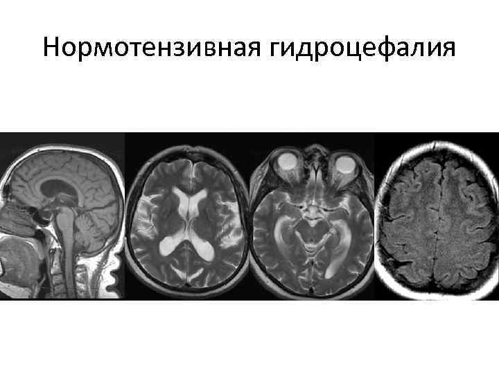 Нормотензивная гидроцефалия 