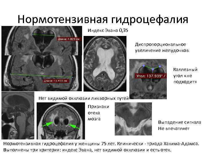 Гидроцефалия на фоне кортикальной атрофии