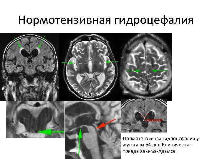 Диета при гидроцефалии мозга. Триада Хакима Адамса нормотензивная гидроцефалия. Открытая гидроцефалия головного мозга кт. Нормотензивная гидроцефалия головного мозга мрт. Гидроцефалия головного мозга на кт.