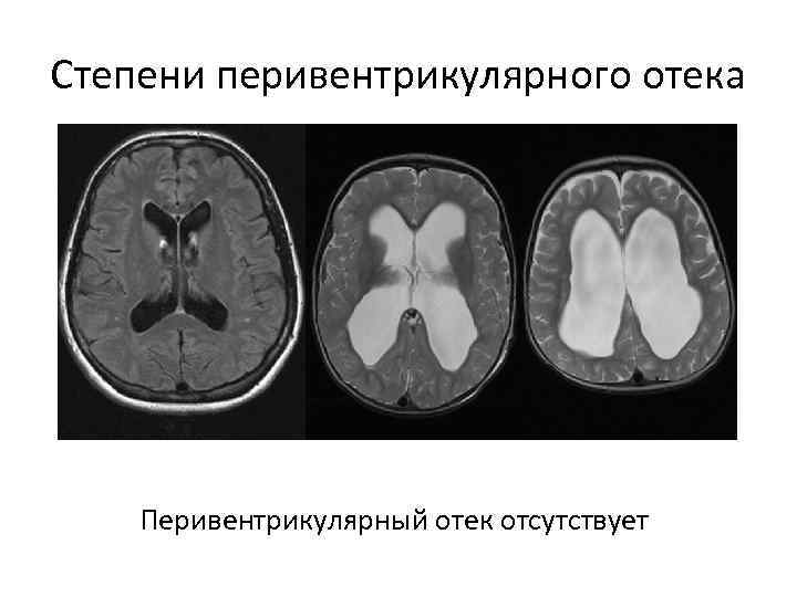 Степени перивентрикулярного отека Перивентрикулярный отек отсутствует 