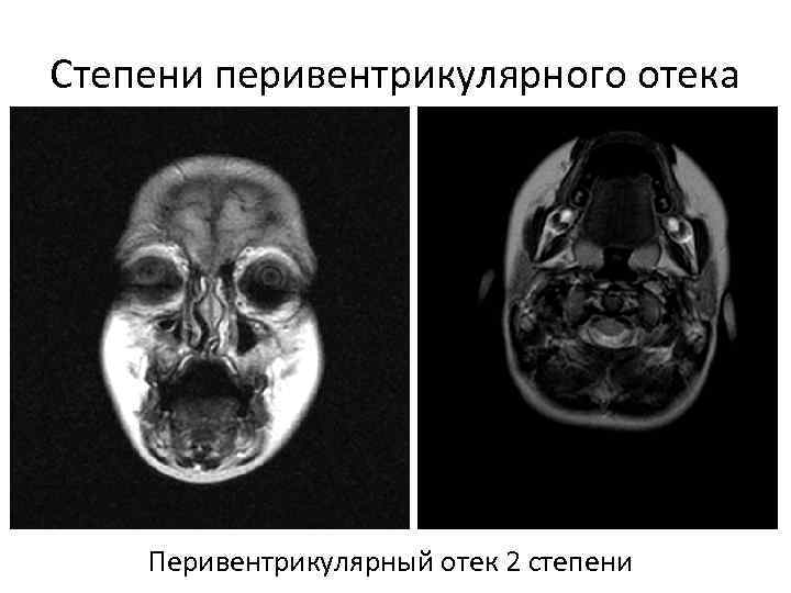 Степени перивентрикулярного отека Перивентрикулярный отек 2 степени 