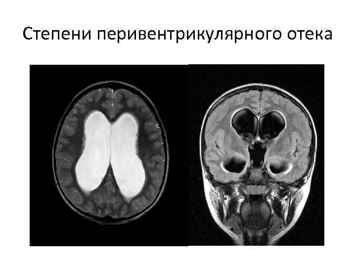 Степени перивентрикулярного отека 