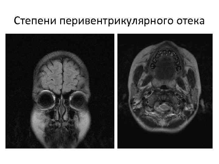 Степени перивентрикулярного отека 