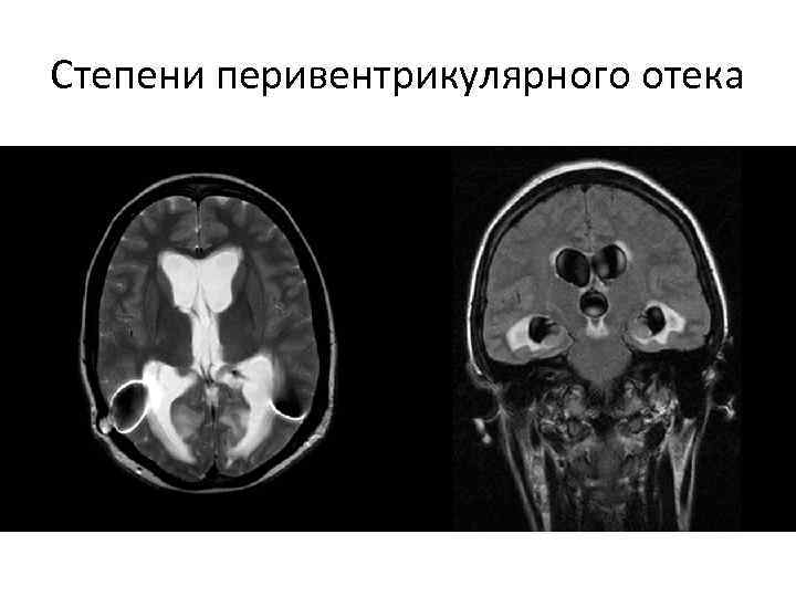 Степени перивентрикулярного отека 