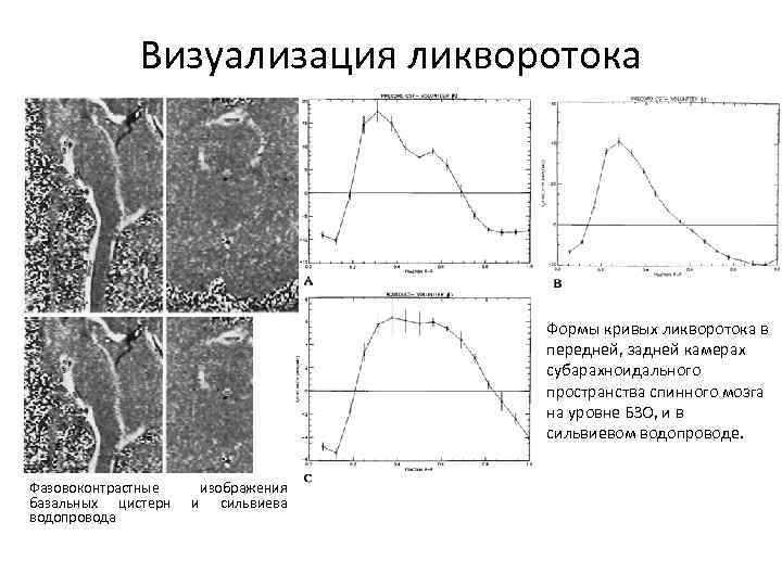 Визуализация ликворотока Формы кривых ликворотока в передней, задней камерах субарахноидального пространства спинного мозга на