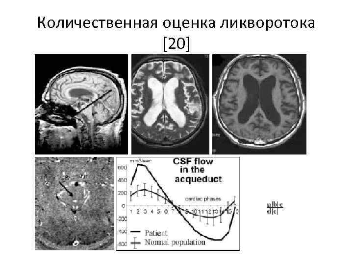 Количественная оценка ликворотока [20] 