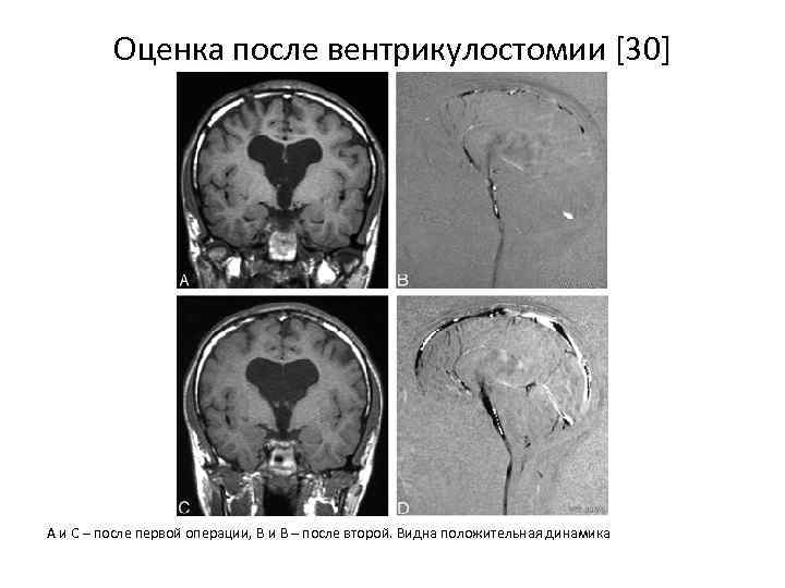 Оценка после вентрикулостомии [30] А и С – после первой операции, В и В