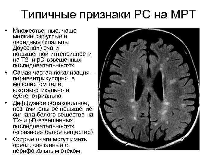 Мрт мозга рассеянный склероз. Очаги демиелинизации головного мозга что это такое. Очаговые изменения дисциркуляторного дистрофического характера