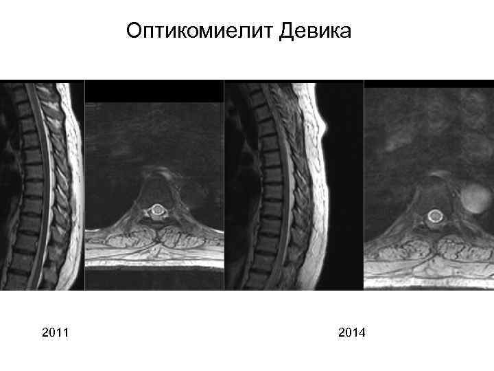 Оптикомиелит