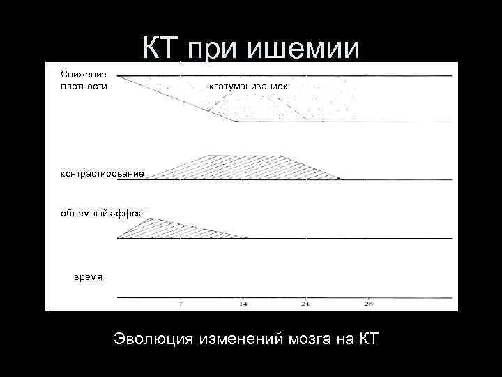 КТ при ишемии Снижение плотности «затуманивание» контрастирование объемный эффект время Эволюция изменений мозга на