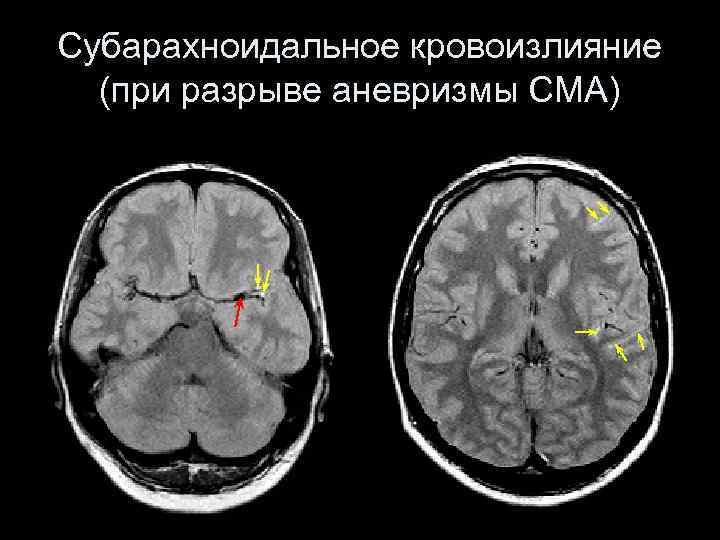 Картинки субарахноидальное кровоизлияние