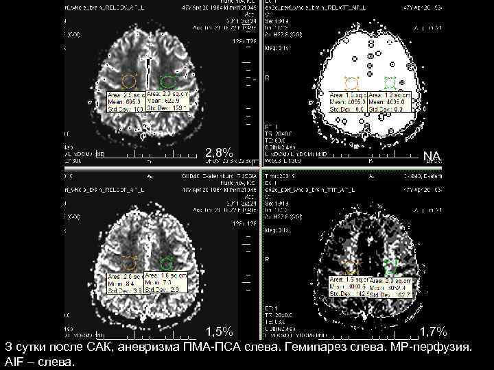 2, 8% NA 1, 5% 1, 7% З сутки после САК, аневризма ПМА-ПСА слева.