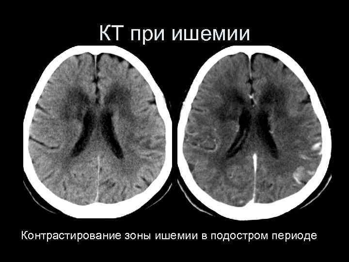 КТ при ишемии Контрастирование зоны ишемии в подостром периоде 