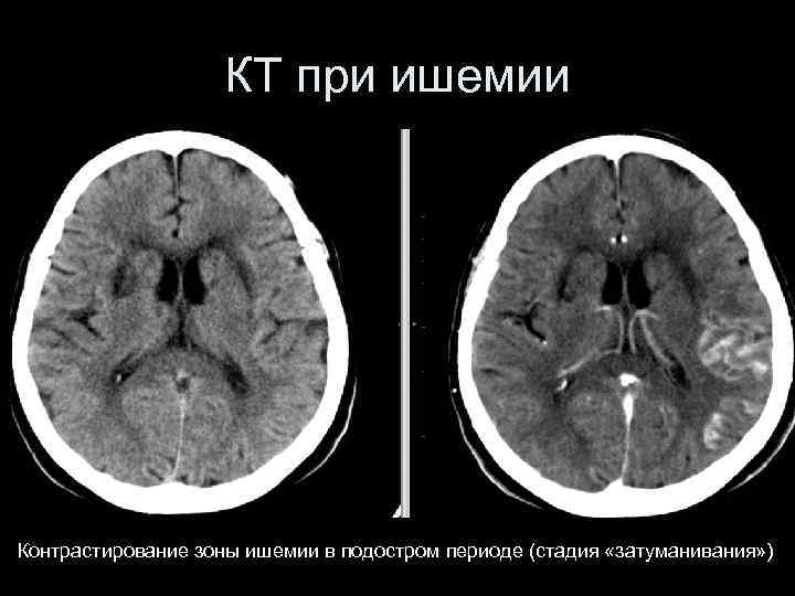 КТ при ишемии Контрастирование зоны ишемии в подостром периоде (стадия «затуманивания» ) 