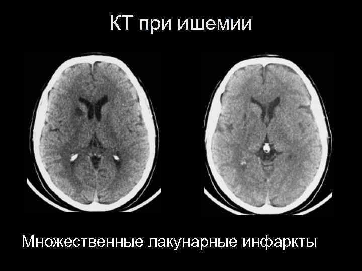 КТ при ишемии Множественные лакунарные инфаркты 