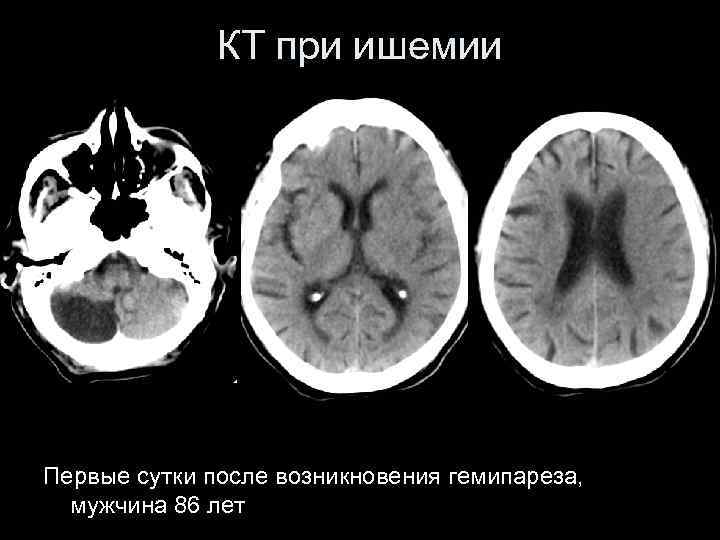 КТ при ишемии Первые сутки после возникновения гемипареза, мужчина 86 лет 